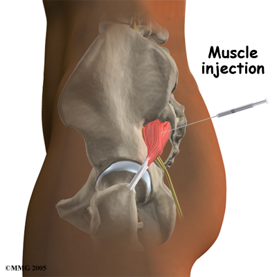 piriformis syndrome • BODY FIRST UK