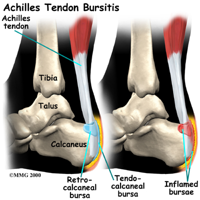 Strapping for achilles on sale bursitis