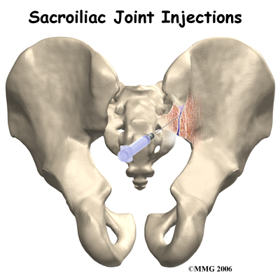 Sacroiliac Joint Treatment London